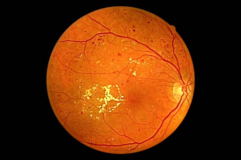 диабет ретинопатия