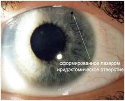 Глаукома лечение в волгограде thumbnail